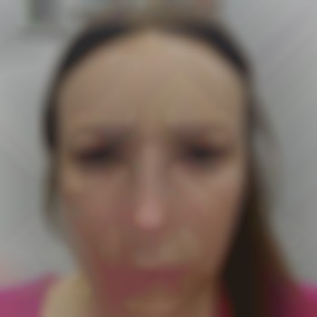 Ботокс чоло💉