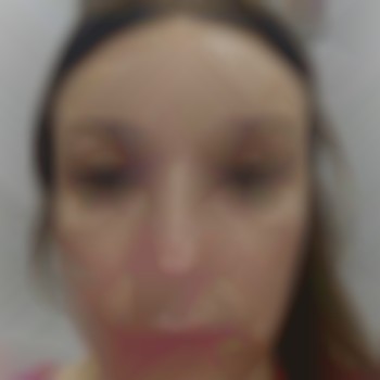 Ботокс чоло.