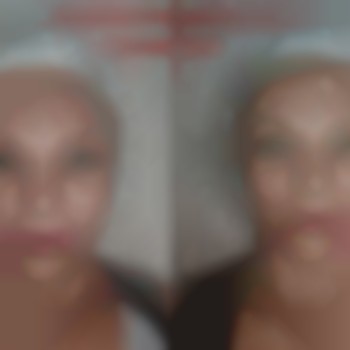  #карбоксітерапія