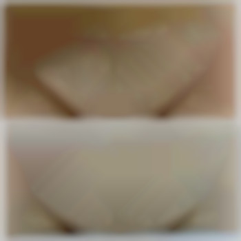 до ле та після 11 процедур