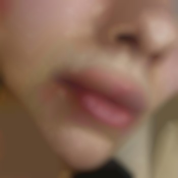 повторне поновлення обʼєму губ.