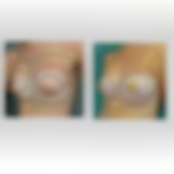 Корекція тубулярності