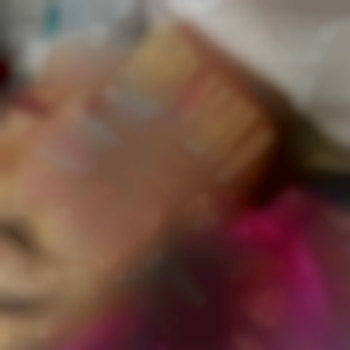 Процедура мезонитки для улучшения качества кожи и устранения возрастных изменений., фото - косметолог-инъекционист Наталья Грицай