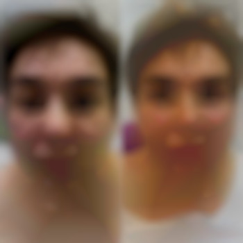 Комплекс процедур для устранения возрастных изменений, фото - косметолог-инъекционист Наталья Грицай