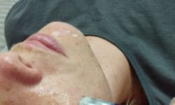 Мікронідлінг (дермапен, фракційна мезотерапія) Врач-косметолог  Хмельницкий