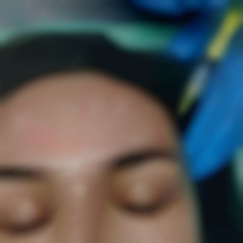 Мезотерапия, фото - косметолог Виктория Носа