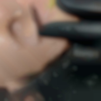 Корекціяшрамів, фото - косметолог Виктория Носа