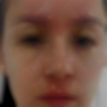 Відразу після процедури