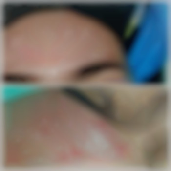   за допомогою розриву фіброзу, введення мезококтейлю