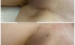 Інтимне відбілювання Мастер депиляции Оксана Киев