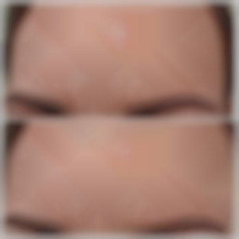 Коррекция пигментных пятен с помощью мезококтейля. Результат – после трех процедур., фото - косметолог Виктория Носа