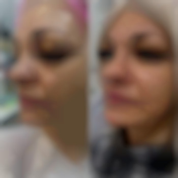 Воспроизведен молодой овал лица. Процедура фулфейс филлерами, фото - косметолог-инъекционист Наталья Грицай