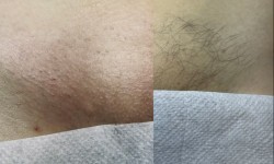 Глибоке бікіні Мастер депиляции Диана Ивано-Франковск