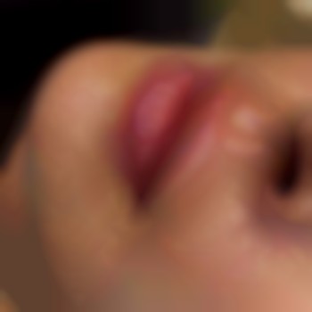  #збільшеннягуб #губифіллер #аугументаціягуб