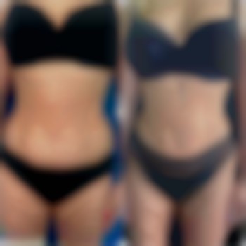 ліпосакция живота