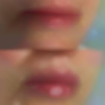 На фото корекція губ в обʼємі 1 мл, препарат Saypha.