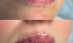 Збільшення губ Косметолог Світлана Ивано-Франковск
