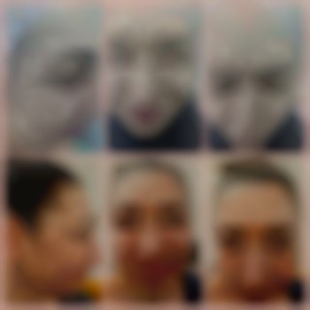  #ботулінотерапія
Зроблено корекцію міжбрів'я та "гусячих лапок"