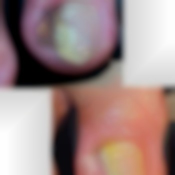 усунення хронічного врослого нігтя. різниця між фото 1 тиждень