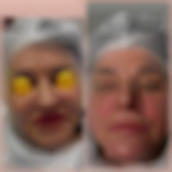 Зроблено заповнення носогубних заломів, кісетних зморшок та міжбрів'я, підняття куточків губ