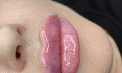 Увеличение губ Косметолог-инъекционист Ольга Харьков