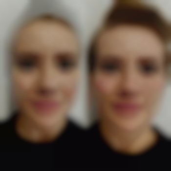 Нитковий ліфтинг обличчя