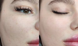 Карбоновый пилинг Косметолог-инъекционист Ольга Харьков