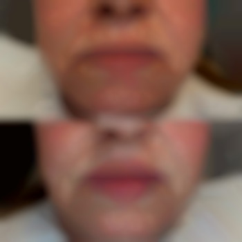 Контурная пластика губ для возрастной девочки 🥀

Препарат был выбран Juvederm smile 0,55ml для деликатного наполнения 👌🏼

*Губки первичны, поэтому решили начать с маленького объема, фото - стоматолог Диана Скоркина