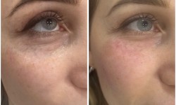 Заполнение носослезной борозды Косметолог-инъекционист Наталья Днепр