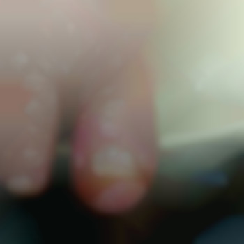 Безболісне видалення врослого нігтя.