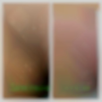 Депіляція зони глибокого бікіні