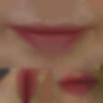 увеличение губ, контурная пластика губ, аугментация губ