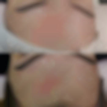 Корекціяшраму корекціярубців видаленняшраму, фото - косметолог Виктория Носа