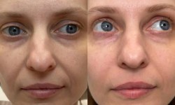 Біоревіталізація -зволоження шкіри обличчя та тіла Косметолог Елена Одесса