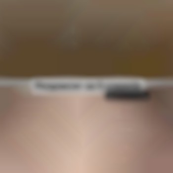 Результат після лазерної епіляції 5 процедур