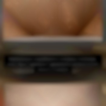 Результат після лазерної епіляції 5 процедур