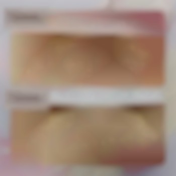 Лазерне видалення волосся