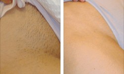 Лазерная эпиляция глубокого бикини Студия красоты LU Днепр