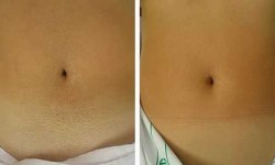 Лазерная эпиляция живота Студия красоты LU Днепр