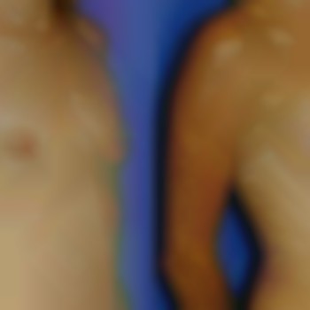 увеличение груди