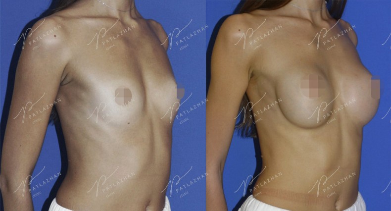 Увеличение груди, фото - Пластический хирург Геннадий Патлажан