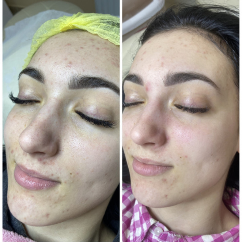 Химический пилинг Sebo, фото -  Ксения Трофименко