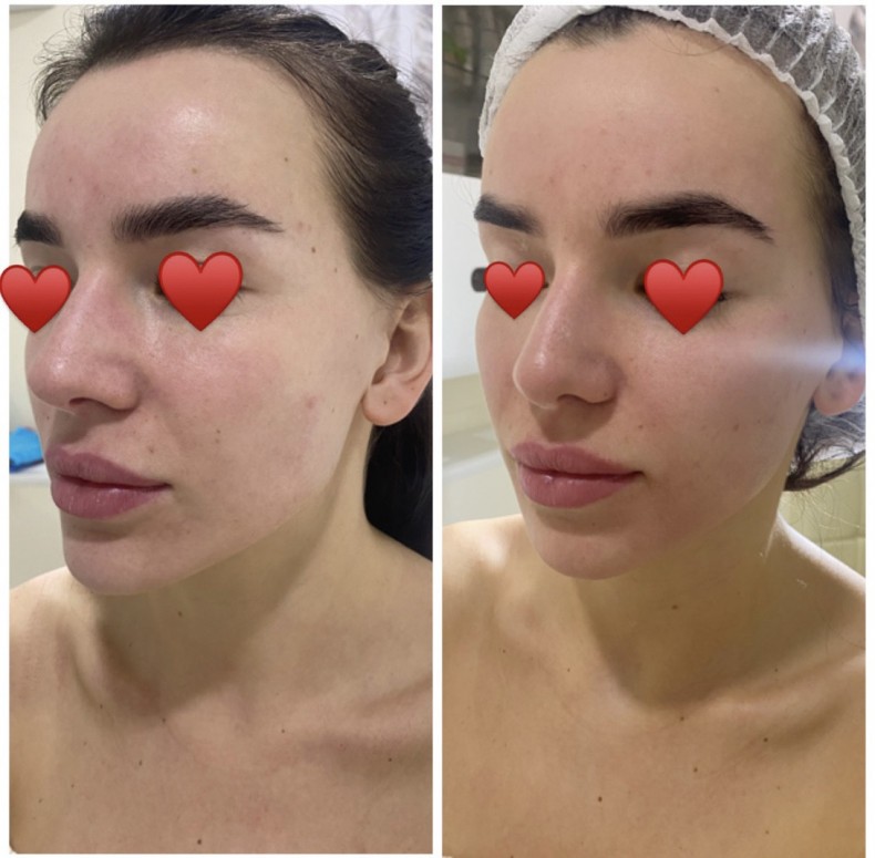 Скульптурирующий массаж лица, фото -  Ксения Трофименко