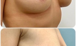 Увеличение груди от 2300€ все включено Медицинский центр Аура Киев