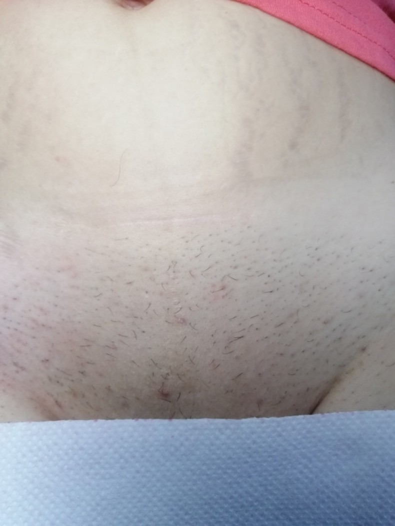 Самое первое фото-регулярно убираются волосы эпилятором, фото - Мастер депиляции Наталья Гук