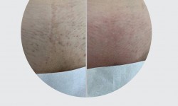 Коррекция и удаление вросших волос Мастер депиляции Ольга Чернигов