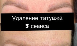 Лазерный карбоновый пилинг Мастер перманентного макияжа Жанна Кривой Рог