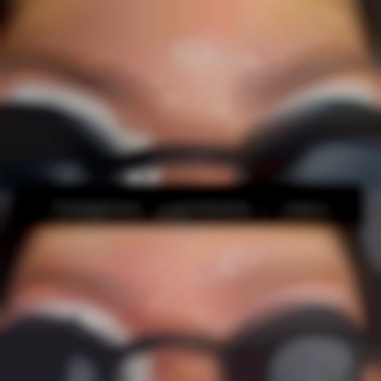 Удаление татуажа лазером