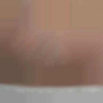 Зона бикини 
Реакция кожи сразу после процедуры