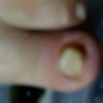 Резекция выросшего ногтя, фото - подолог Яна Владимировна Пичугина